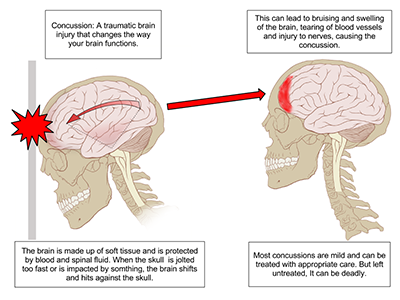 New information on concussions shows how harmful they can be to athletes.